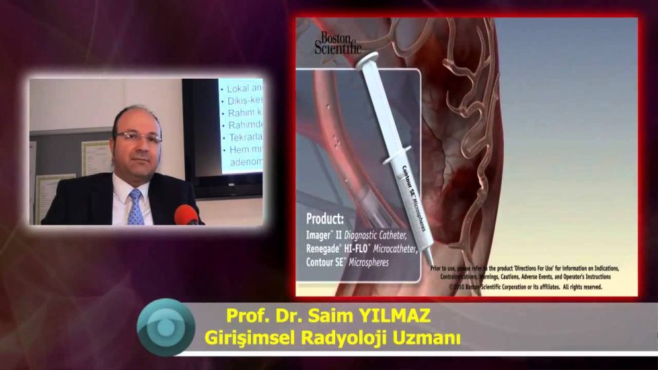 Miyom Embolizasyonu Adenomiyozis Avantajları Nelerdir Kadınlarda Miyom Tedavisi