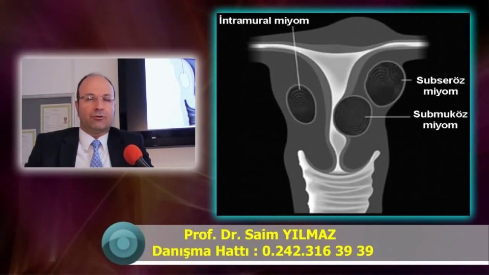 Miyom Nedir Belirtileri Nelerdir Kadınlarda Miyom Hamilelikte Miyom Rahimde Miyomlar